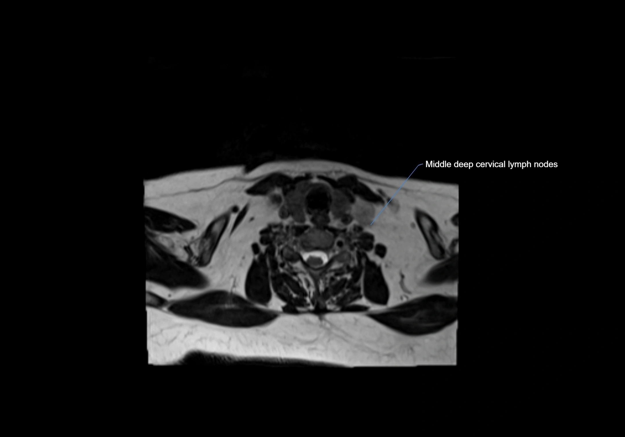 Neck axial  lymph node cross sectional MRI anatomy 3T MRI  image-img-00001-00077.webp